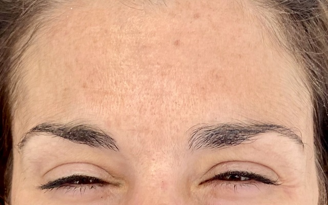 Después - Caso Botox 2