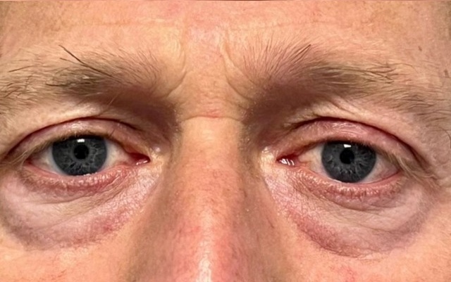 Antes - Caso Bioestimuladores