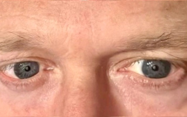 Después - Caso Bioestimuladores