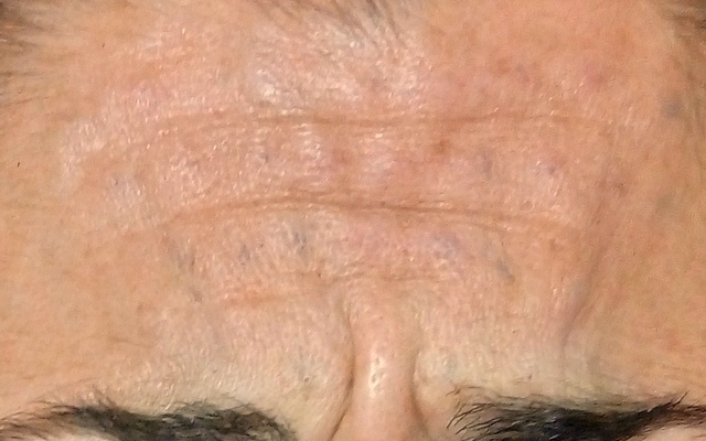 Antes - Caso Botox 2