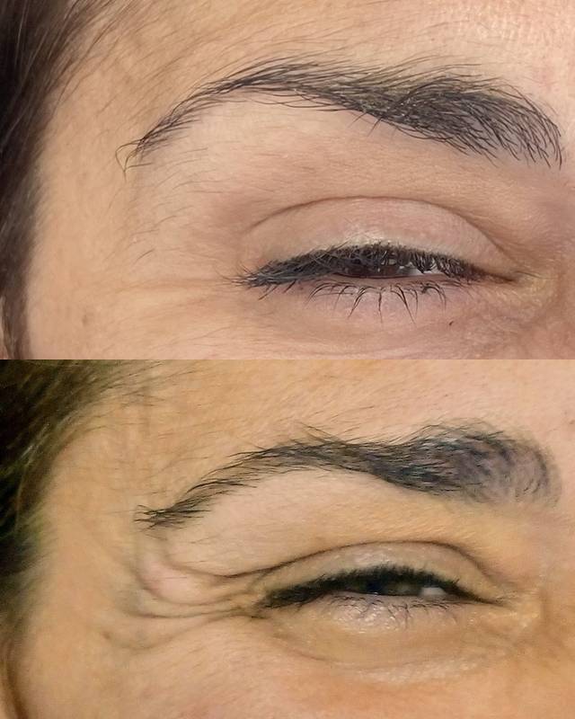 Toxina Botulínica - Antes y Después
