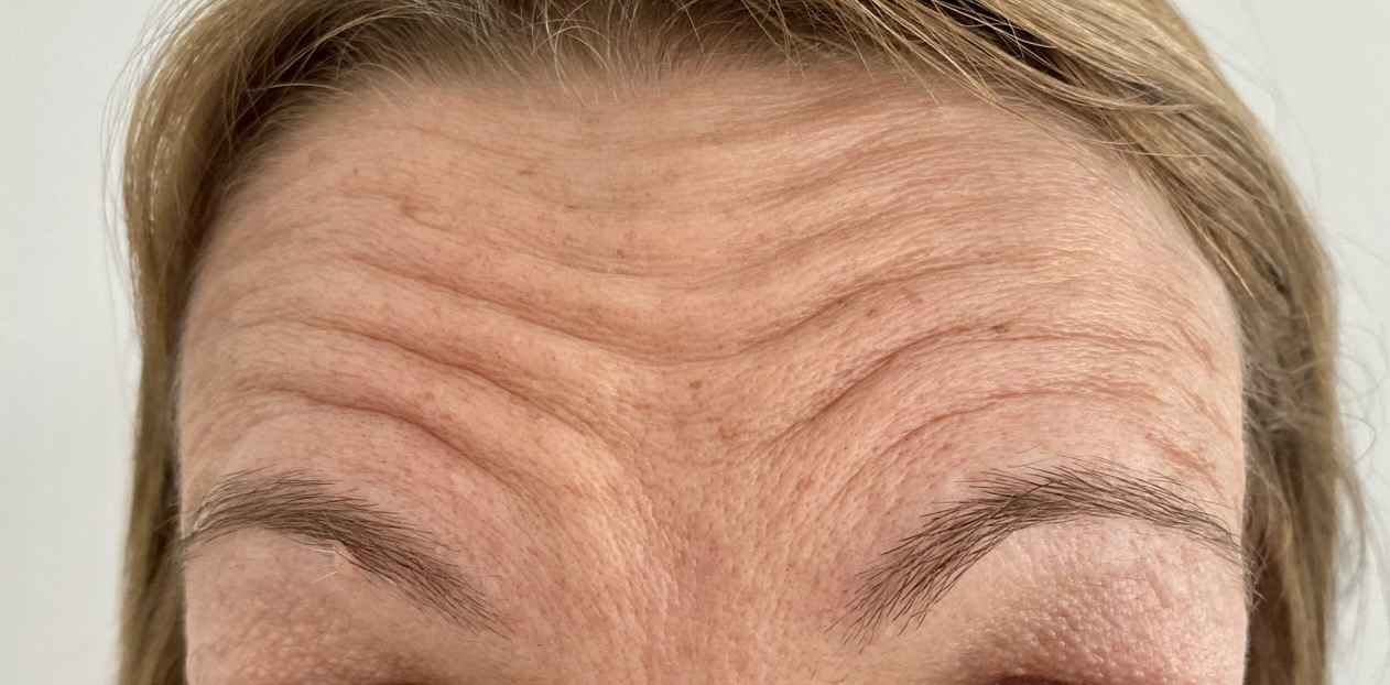 Antes - Caso Botox 3