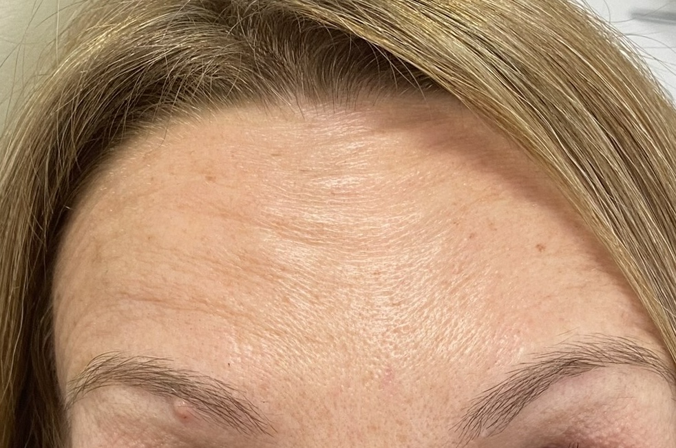 Después - Caso Botox 3