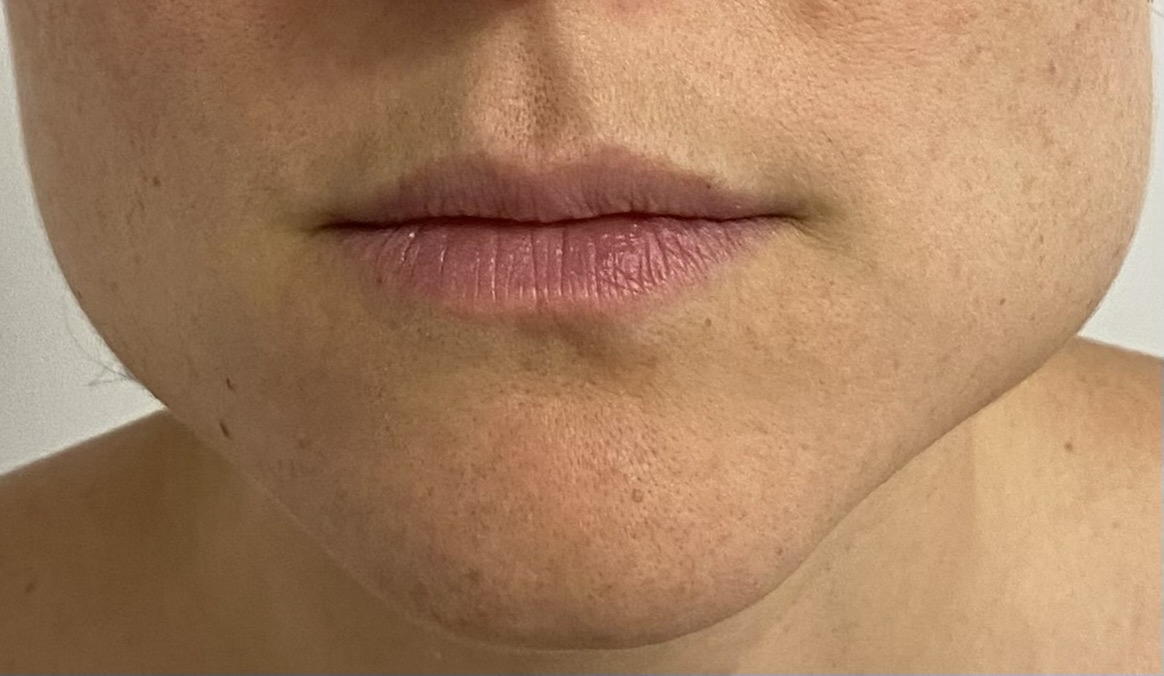 Caso de recuperación Antes