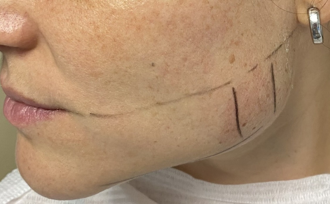 Toxina Botulínica en Maseteros